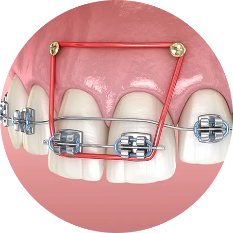 歯科矯正用アンカースクリューを用いた矯正治療
