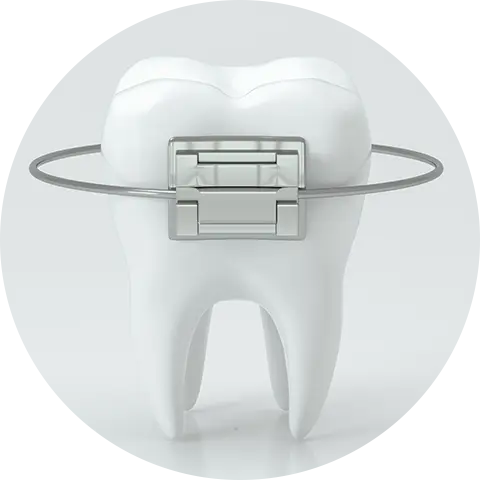 部分的な矯正(MTM)