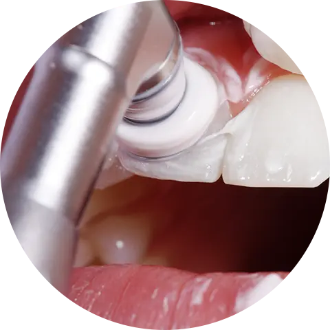 歯のクリーニング